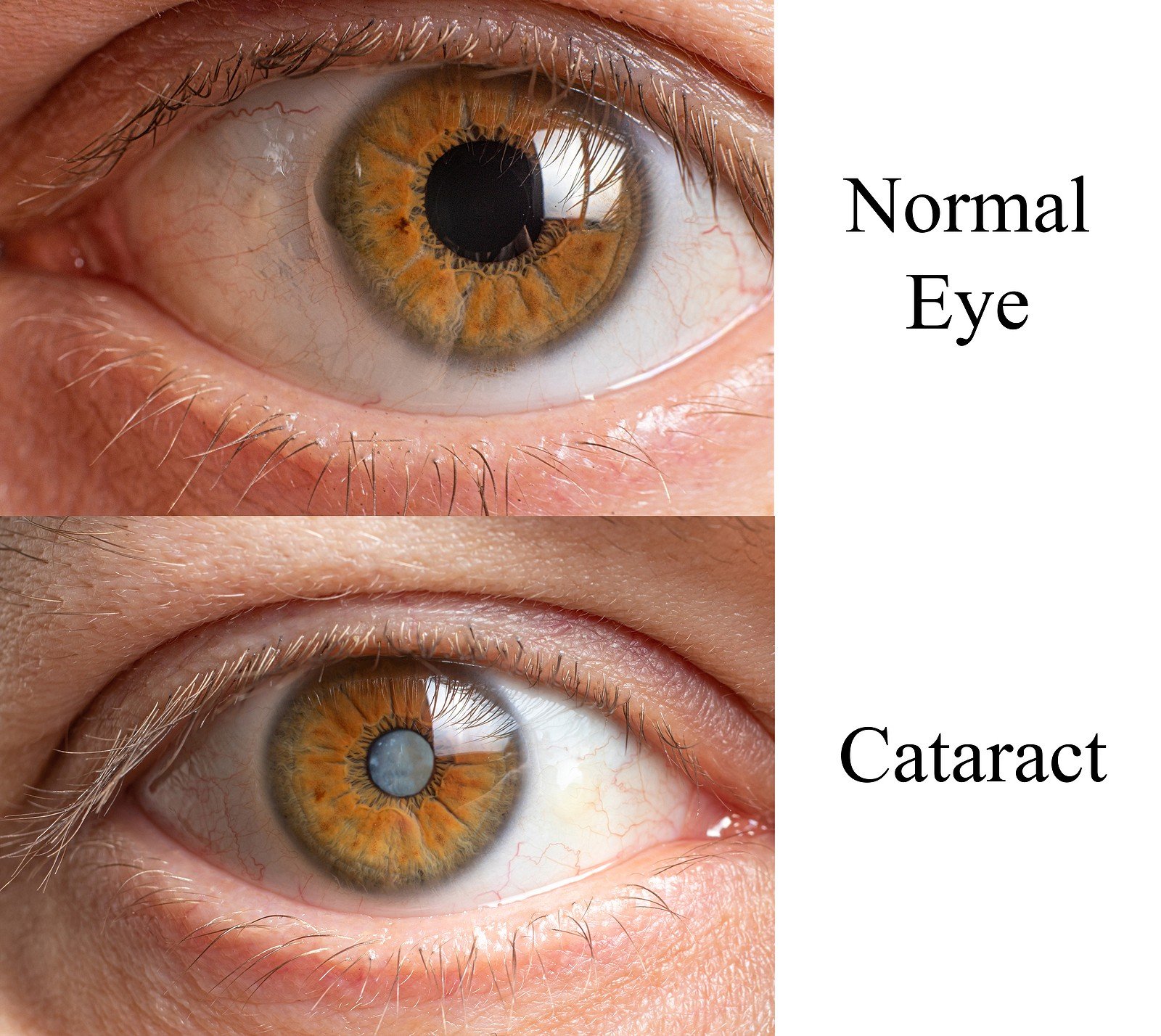 cataract1
