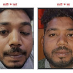 (Ptosis)पटोसिस आँख के  ऊपर की  (पलक झुकना)