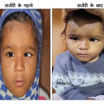 आँखों में तिरछापन (Squint )