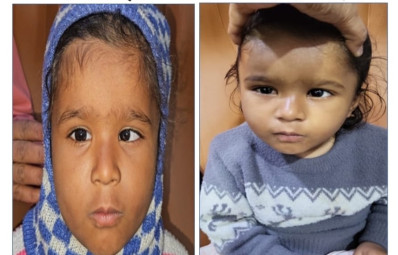 आँखों में तिरछापन (Squint )