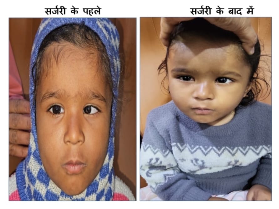 आँखों में तिरछापन (Squint )